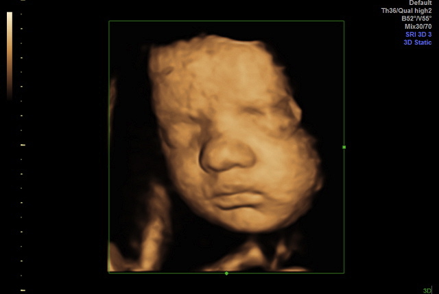 Hvad forskellen på 2D, 3D og scanning af gravide? Signes Scanningsklinik