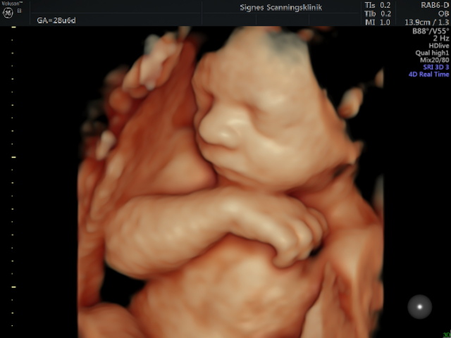 Hvad er forskellen på 2D, 3D og 4D scanning af gravide?