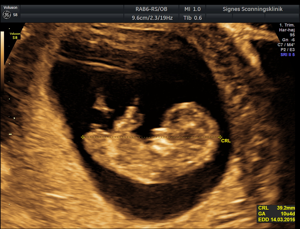 Scanningsbillede af foster i uge 10+4, uge 11.
