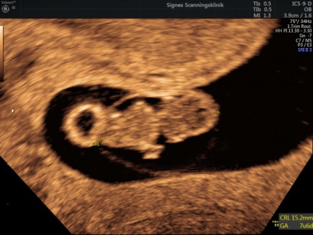 Gravid uge 8 9. graviditetsuge